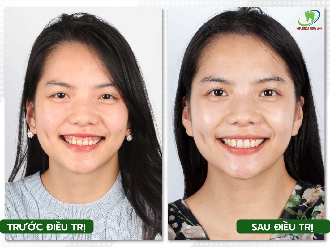 Top 8 Địa chỉ cắt lợi uy tín nhất TP. Hồ Chí Minh